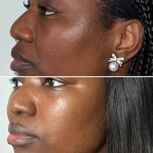 Balanced skin tone — before and after