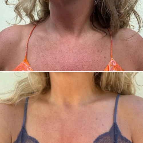 Improved skin texture — before and after