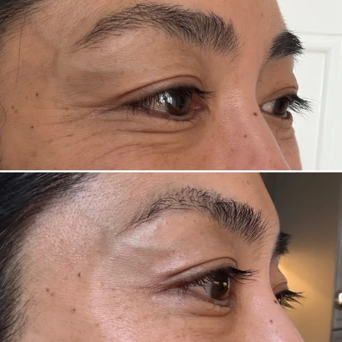 Reduced fine lines & wrinkles — before and after