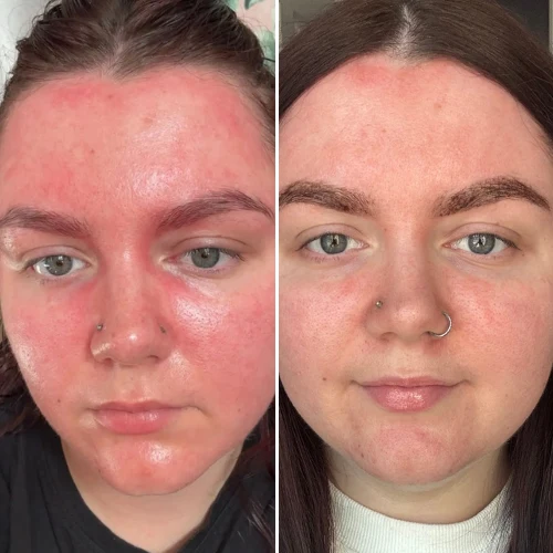 Reduced redness & irritation — before and after