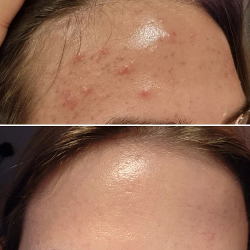 Clearer, calmer skin — before and after